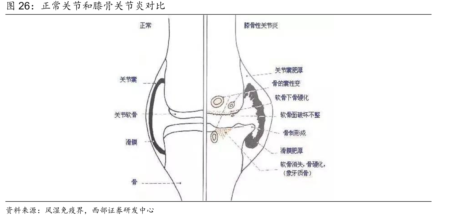正常关节和膝骨关节炎对比