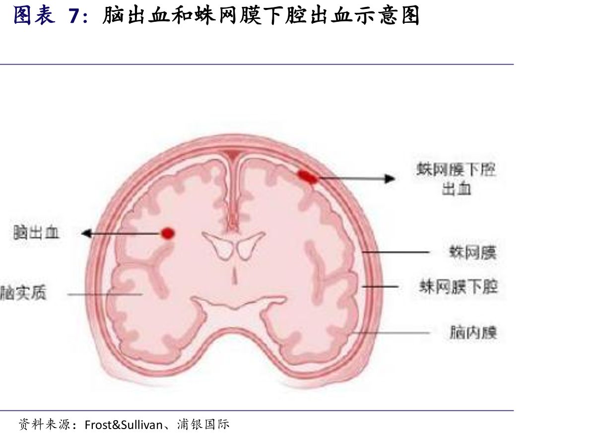 我国脑卒中及脑动脉粥样硬化狭窄患者_第5页