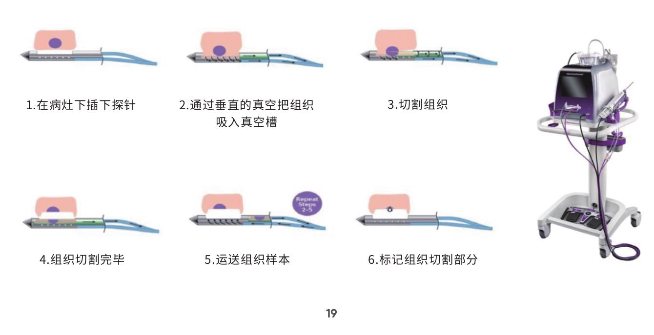 郑州市乳腺超声检查的女性用户中乳腺结节检出率的年龄分布与全国对比_第4页