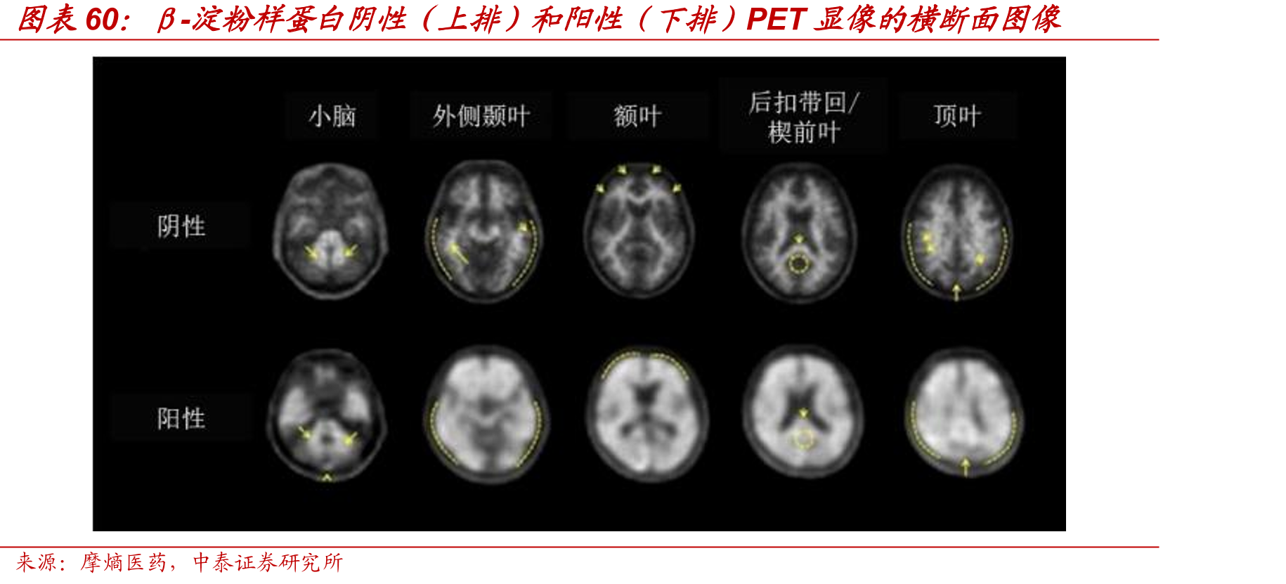 正常大脑与阿尔茨海默症患者大脑和神经元生理结构_第5页